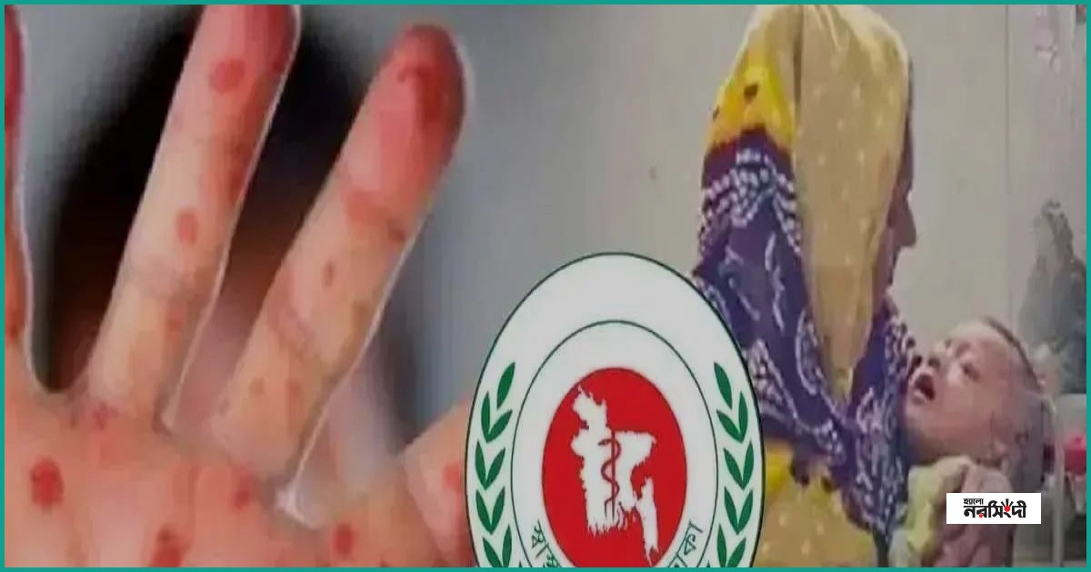 দেশে হাম ও উপসর্গে আরও ৫ শিশুর মৃত্যু