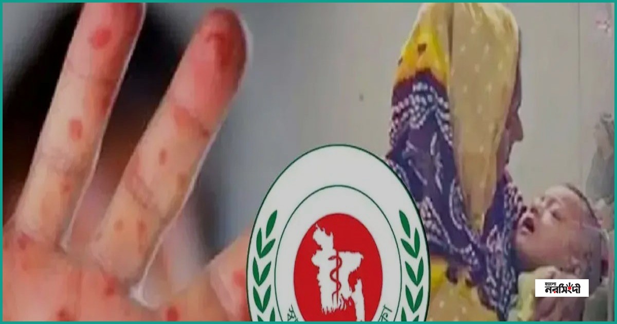 দেশে হামে মৃত্যুর সংখ্যা ৮৩১, একদিনে প্রাণ গেল ৩ শিশুর