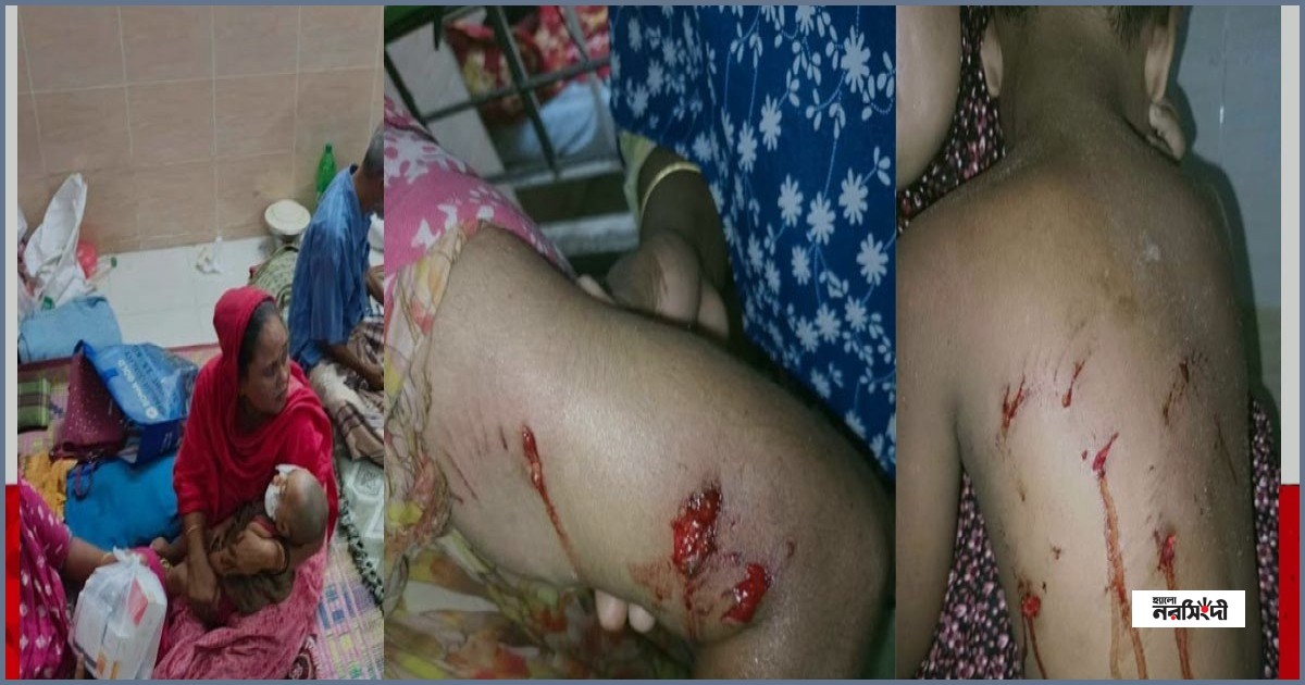 পাবনায় কুকুরের কামড়ে নারী ও শিশুসহ ১১ জন আহত