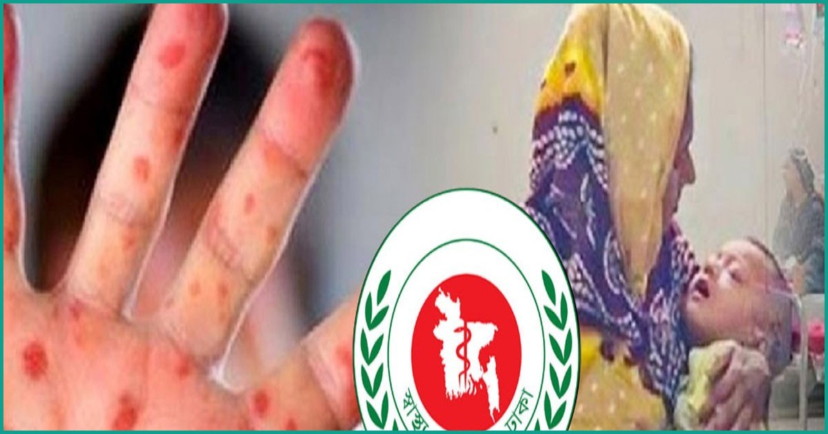 দেশে হামের প্রকোপ: ২৪ ঘণ্টায় ৫ শিশুর মৃত্যু, আক্রান্ত ১০৭৭
