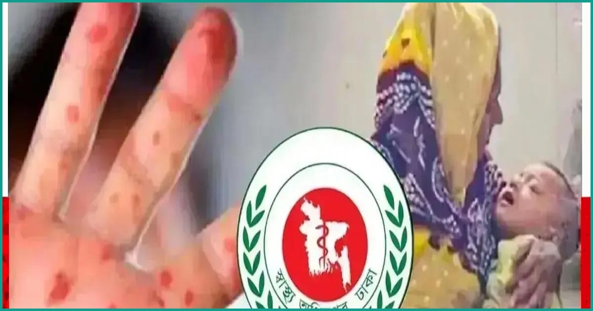 হাম ও উপসর্গে আরও ৪ জনের মৃত্যু, নতুন শনাক্ত ৯৯
