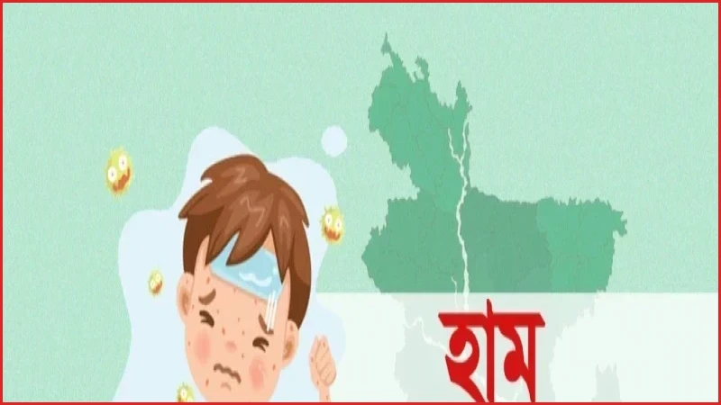 হামের উপসর্গে আরও চারজনের মৃত্যু, আক্রান্তের সংখ্যা বাড়ছে
